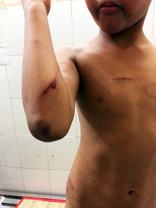 Bắt giam cha dượng bạo hành dã man con riêng của vợ